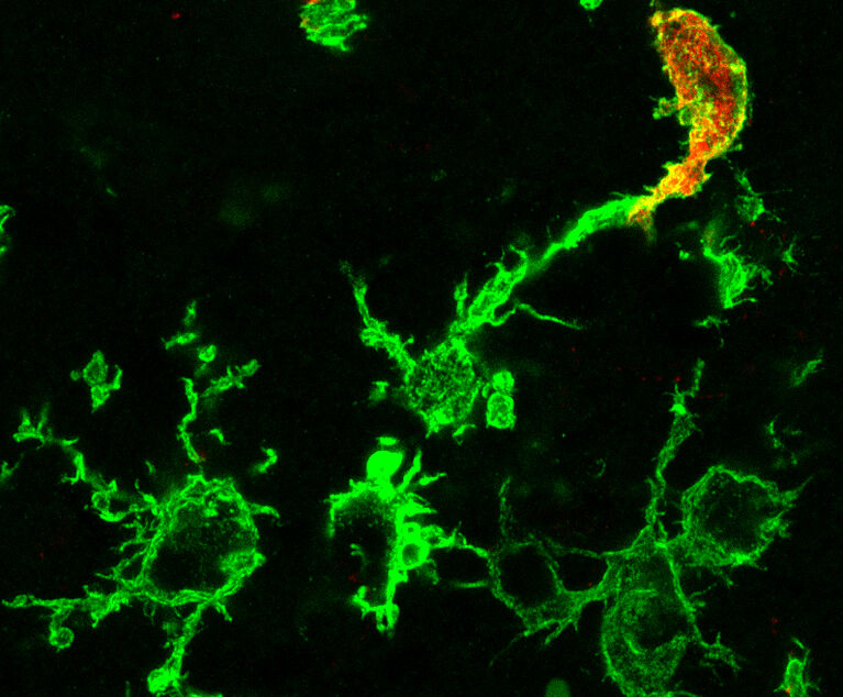 Mikroskopisches Bild von grün angefärbten Makrophagen nach einem Schlaganfall: Die zusätzlich rot gefärbte Zelle (r.o.) entstammt dem Knochenmark, die rein grünen Zellen sind ansässige Mikroglia. Bild: AG Stumm/UKJ