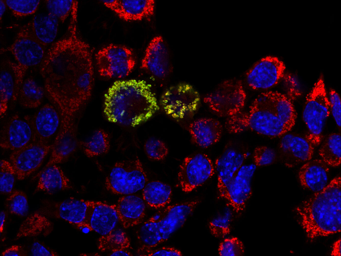 In kultivierter Nervenzellen zeigt sich das grün angefärbte Protein HPDL in den rot angefärbten Mitochondrien durch Überlagerung in Gelb. Bildquelle: UKJ