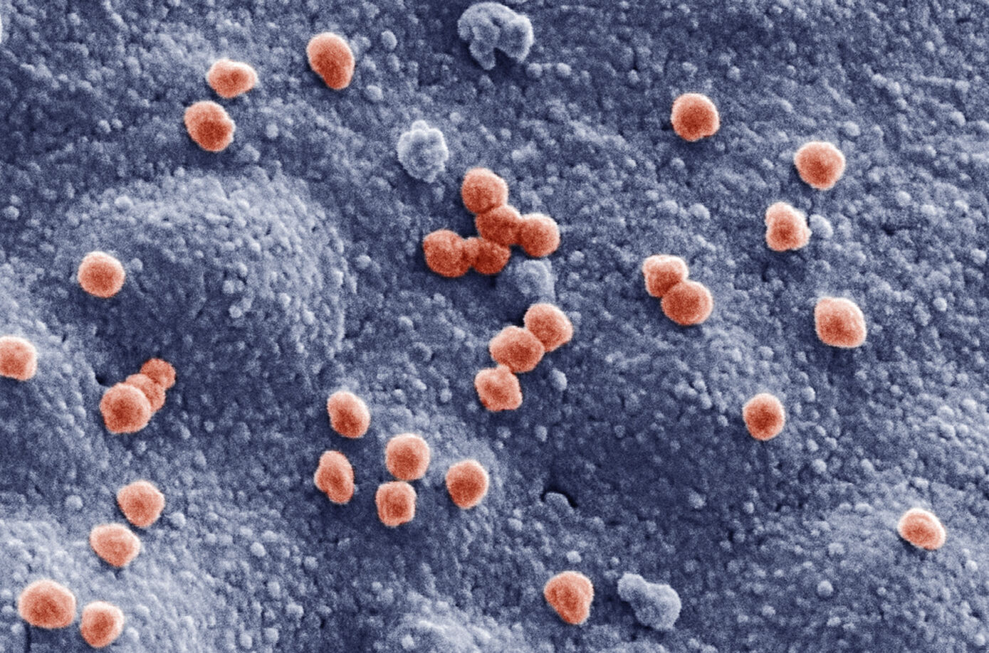 SARS-CoV-2 viruses (Ø 83 nm) on the surface of a cultured lung cell. REM, colored.