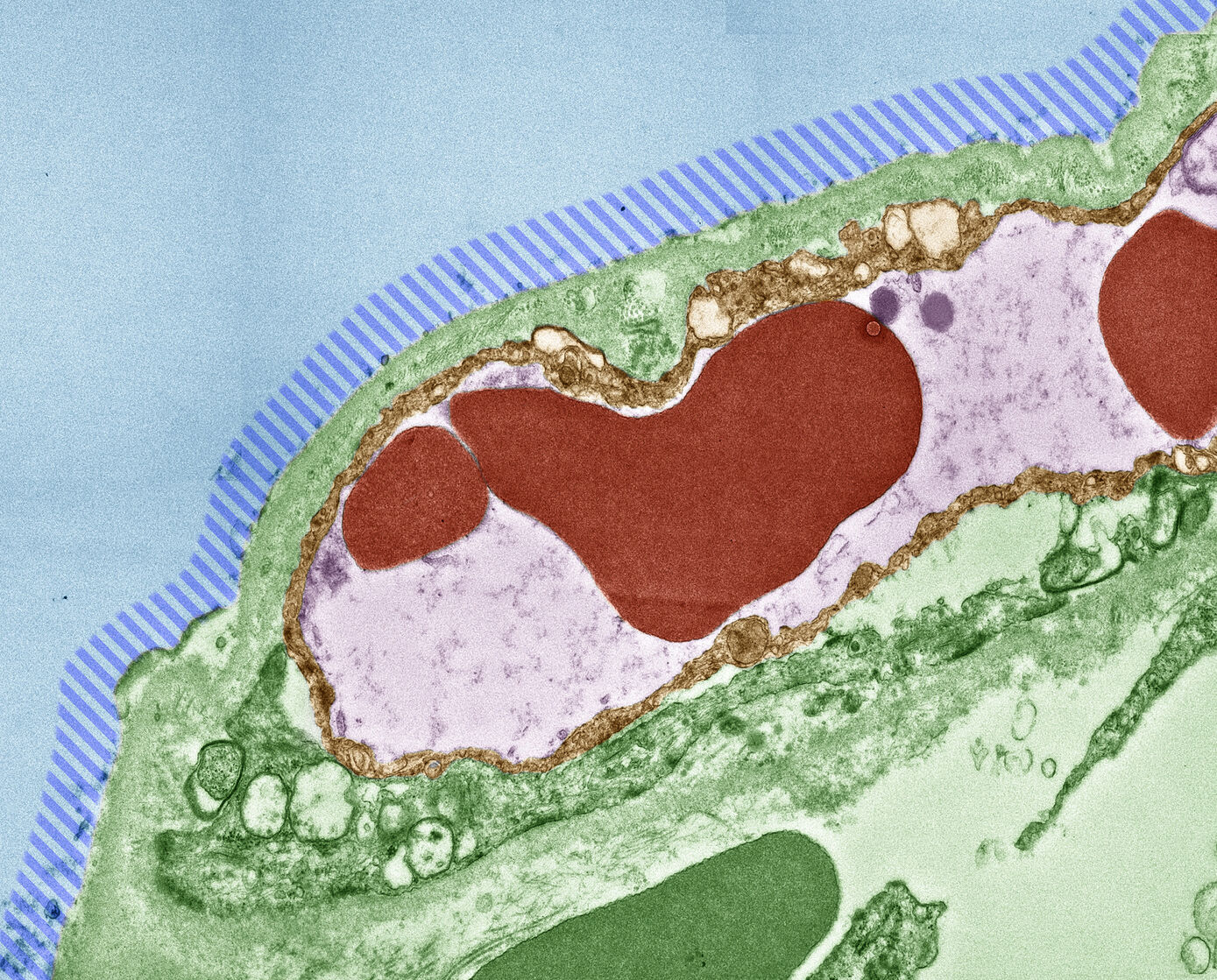 COVID-19 tissue damage in the lungs: In the striped area, the cell layer that produces the surface-active substances necessary for the function and stability of the alveoli is missing. Red: blood cells, blue: breathing air. TEM, colored 
© Dr. Sandor Nietzsche, Electron Microscopy Center 