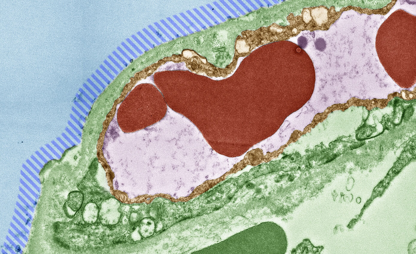 Electron microscope image (subsequently colored) of the blood-air transition in the alveoli of a patient who died of COVID-19. Due to the virus-related dying of the lung epithelial cells, the surface-active surfactant is missing in the blue striped area.