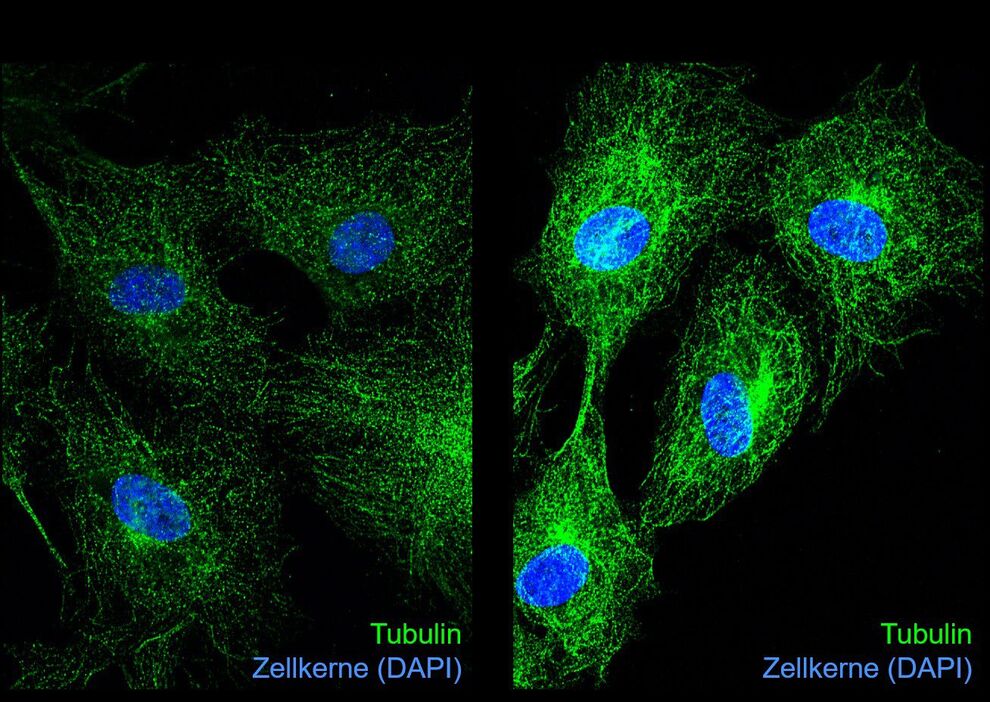 Immunfluoreszenzaufnahmen von Tubulin (grün) und Zellkernen (blau) in unbehandelten
(links) und Glyoxal-behandelten Endothelzellen (rechts). Die Glykierung von Tubulin durch
Glyoxal führt zu veränderter Mikrotubuli-Dynamik und Hemmung der Zellteilung. Bild: Katrin Spengler/UKJ