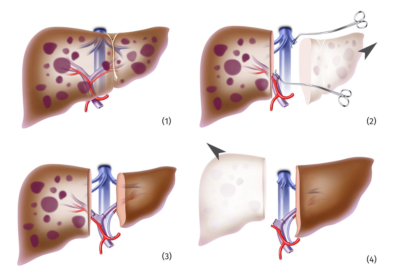 Two-step transplantation: If, for example, the entire liver is affected by metastases (1), first the left-sided liver lobe is removed (2) and replaced with the healthy partial organ from a living donor. The reduced blood flow to the remaining part of the liver stimulates graft growing (3) until after about 2 weeks it adopts complete organ function and the remaining diseased part is removed (4).  Graphics: Jens Geiling/UKJ 