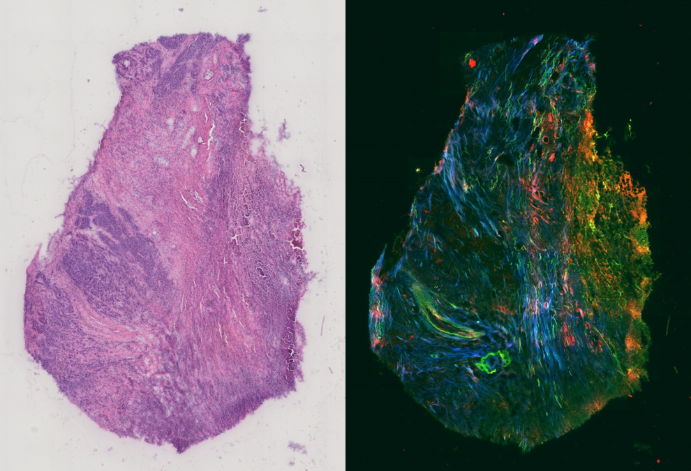 Kopf-Hals-Tumor im Gewebeschnitt (li.) und in der Überlagerung der Bildgebungstechniken Coherent anti-Stokes Raman scattering (CARS, rot), Two-photon excited fluorescence microscopy (TPEF, grün) und Second harmonic generation microscopy (SHG, blau). 