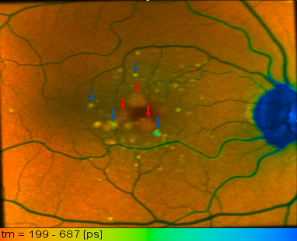 Activated (red arrows) and migrated (blue arrows) RPE in a FLIO image of an AMD patient