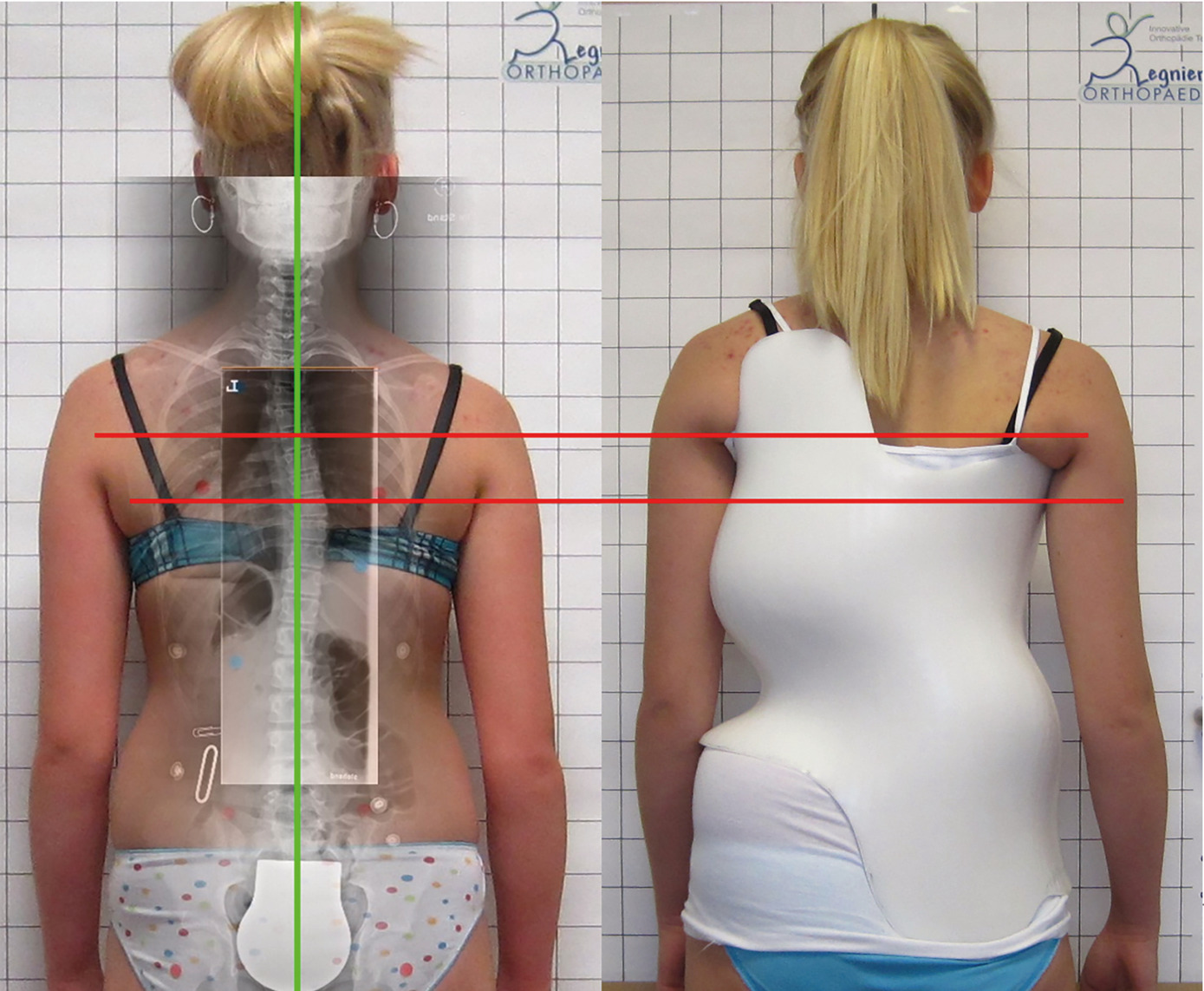 The image illustrates an example of a scoliosis correction using bracing in a thoracic single curve patient with treatment success. The red lines show the apex of the thoracic curve and of the high-thoracic counter-curve (visible in the overlay of the X-ray, left) in relation to the position of the thoracic and shoulder pads (right), which push the spine into correction. The green line shows the central position of the head over the pelvis in the brace (X-ray) as well as clinically after successful treatment (left).