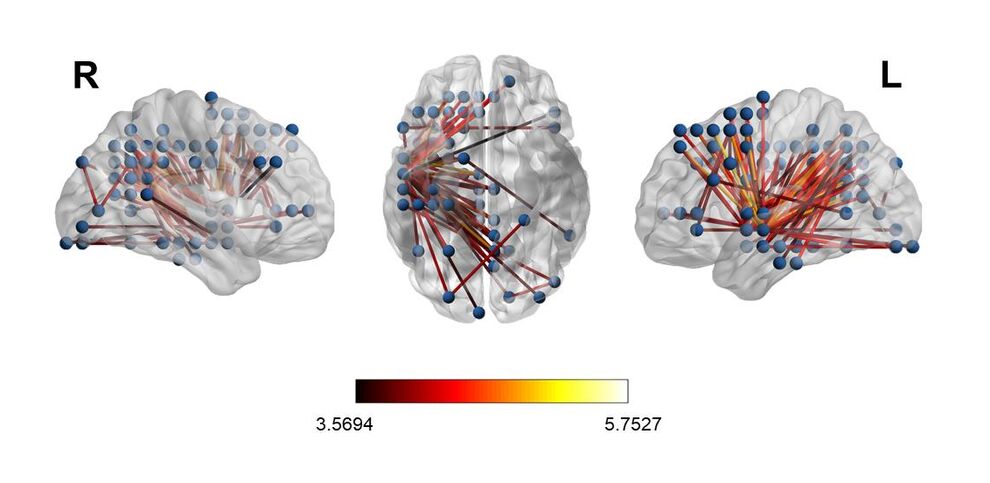 Comparison of the cortical connectivity of the tinnial frequency and a control frequency 