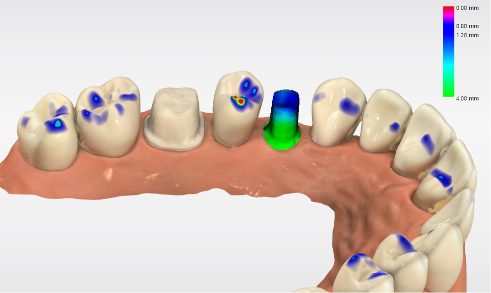 Visualization of ‚PrepCheck‘. The color gradient of the prepared tooth indicates whether the required space is sufficient for the restoration or if further preparation is necessary.
