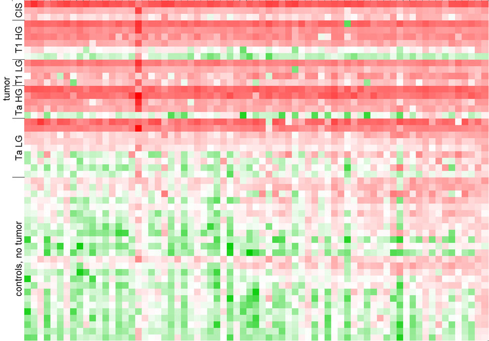 Genome-wide screening using next generation sequencing identifies biomarkers in urine for the diagnosis of urothelial bladder carcinoma. 