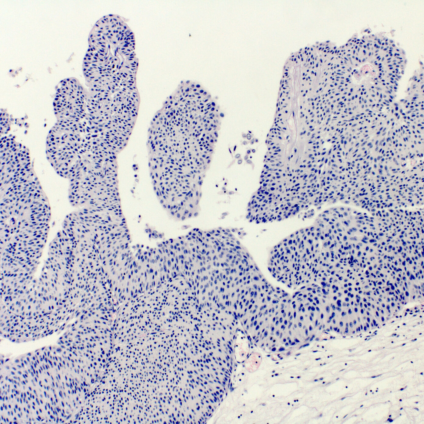 The progression of non-muscle invasive urothelial carcinoma  ...