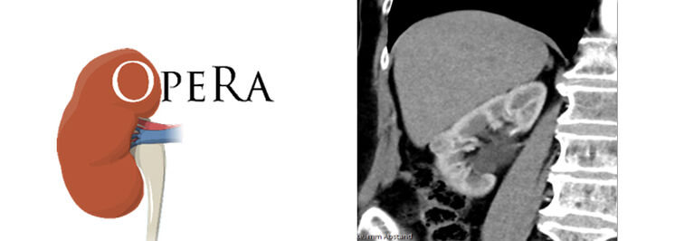 OpeRa - a randomized trial compares open vs Robotic-Assisted partial nephrectomy.