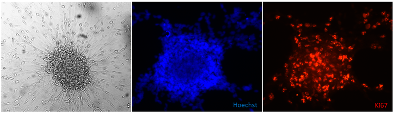 Tumor stem cells isolated from glioblastoma tissue. Left: differentiating tumor stem cells (brightfield, 50x); Middle / right: nuclear staining (blue) and staining of the proliferation marker Ki67 (red) spheroid glioblastoma stem cells (200x) 