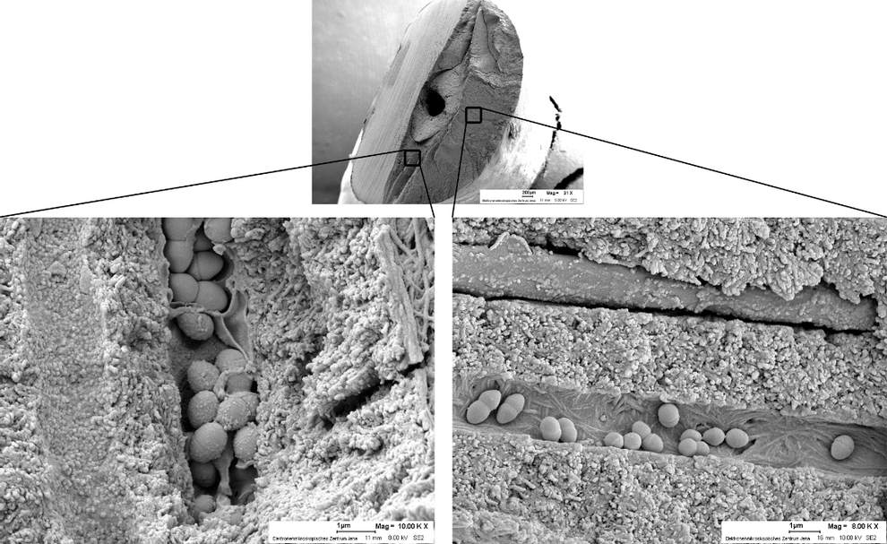 Rasterelektronenmikroskopische Aufnahmen der mit E. faecalis infizierten Dentintubuli.