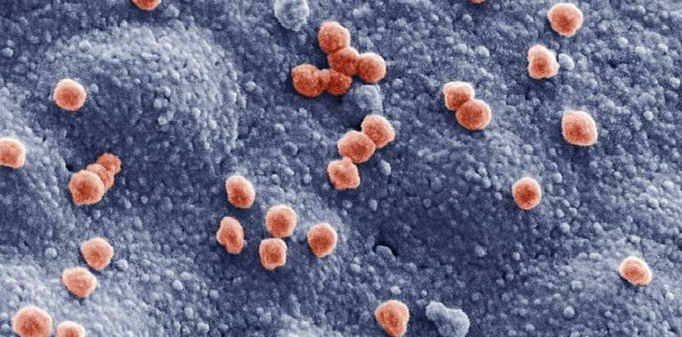 Elektronenmikroskopische Aufnahme (nachträglich koloriert) von SARS-CoV-2 Viren (rot, Durchmesser ca. 83 Nanometer) auf der Oberfläche einer im Laborexperiment untersuchten Lungenzelle.