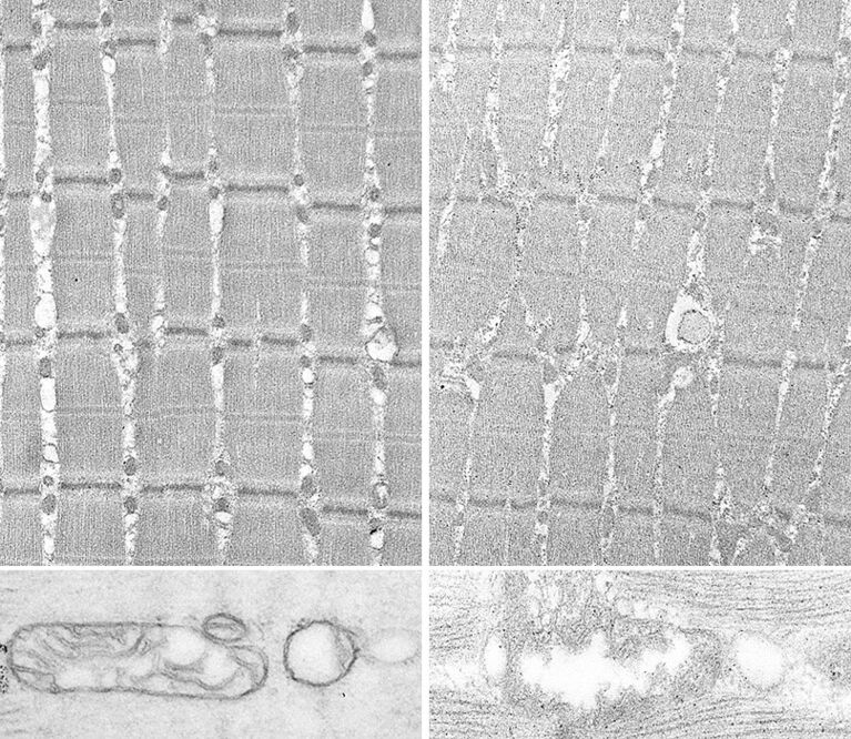 Electron microscopic evidence of reduction and degeneration of mitochondria in thigh muscle tissue of heart failure patients with reduced left ventricular ejection fraction. (Comparison: left: healthy, right: heart failure).
