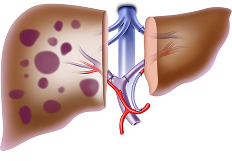 3. Auxiliäre Transplantation des links-lateralen Leberlappens eines Lebendspenders 