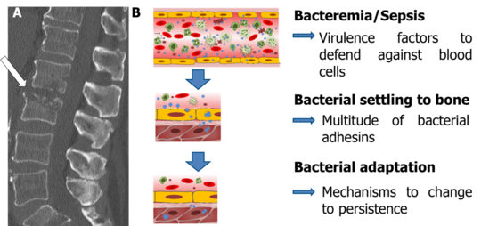 A: S. aureus spondylodiscitis/osteomyelitis with bone destruction; B: Pathogenic steps that induce a hematogenous osteomyelitis