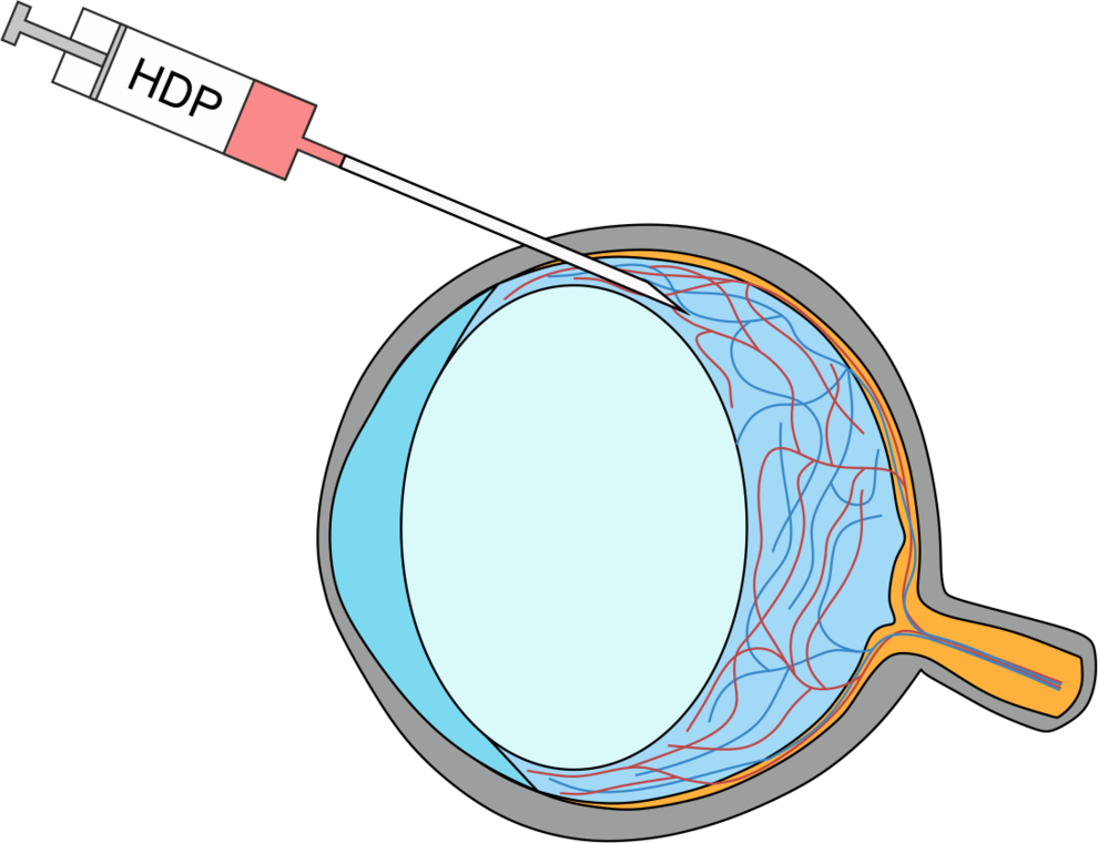 Abbildung 2: Intraokuläre Application von Hämabbauprodukten vor der retinalen Gefäßanalyse.