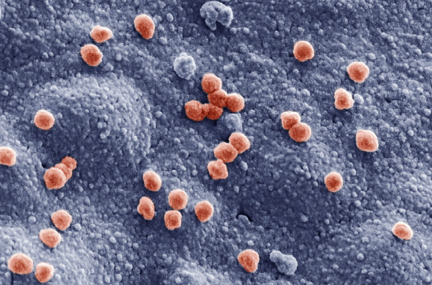 SARS-CoV-2 Viren (Ø 83 nm) auf der Oberfläche einer im Laborexperiment untersuchten Lungenzelle. Aufnahme EMZ, nachkoloriert.
