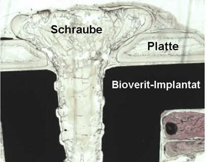 (Dünnschliff-Präparat): Knochen-Implantat (Bioverit-Biokeramik, Polymer) und Gewebe (Knochen, Bindegewebe) - HE-Färbung