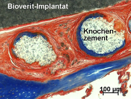 (Dünnschliff-Präparat): Knochen-Implantat (Bioverit-Biokeramik,Knochenzement) und Gewebe (Knochen, Bindegewebe) - Masson-Goldner-Färbung