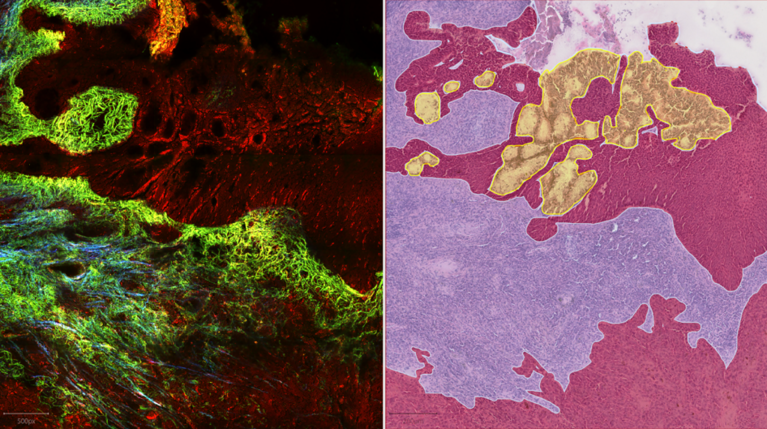 Histologisches Schnittpräparat eines Plattenepithel-Karzinoms mit Fluoreszenz-Anregung von Indocyanin-Grün (rot) und Bindegewebe (grün), aufgenommen mit dem ZEISS Axio Scan.Z1 (ZEISS Microscopy, Oberkochen, Germany)