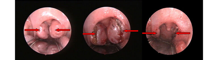 Stark vergrößerte Gaumenmandeln vor Operation (links) Blutungsarmes Schneiden mit dem CO2-Laser (mitte) und verbleibendes Mandelgewebe
am Ende der Operation (rechts)