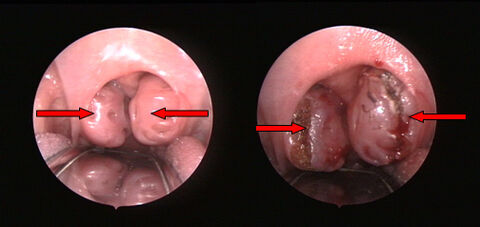 Stark vergrößerte Gaumenmandeln vor Operation (links)
und Blutungsarmes Schneiden mit dem CO2-Laser (rechts)