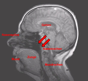 Lokalisation des Nasenrachens an Hand eines MRT-Bildes