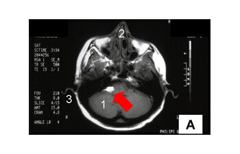 Beispiel für ein Vestibularis-Schwannom in der Kernspintomographie