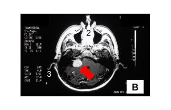 Beispiel für ein Vestibularis-Schwannom in der Kernspintomographie