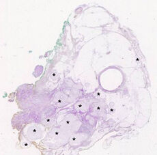 Feingeweblicher Schnitt durch ein Präparat eines Rezidivs eines pleomorphes Adenom mit vielen Knoten (einige markiert*) im und außerhalb der alten Operationsnarbe