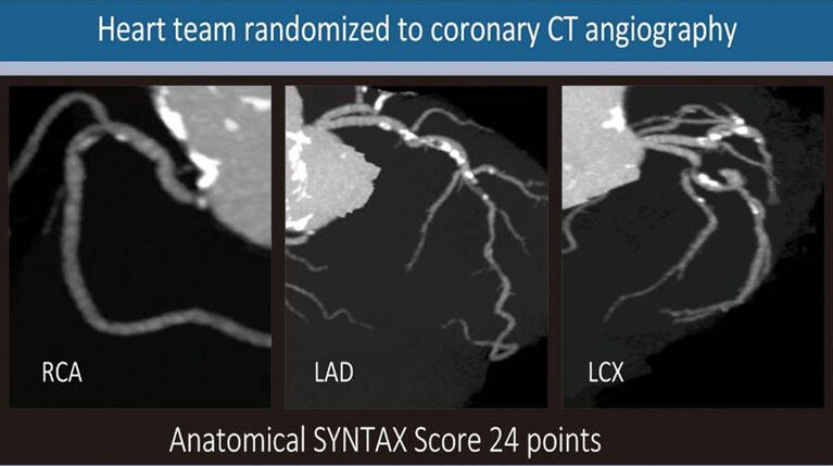 Herzkranzgefäßdarstellung mit CT