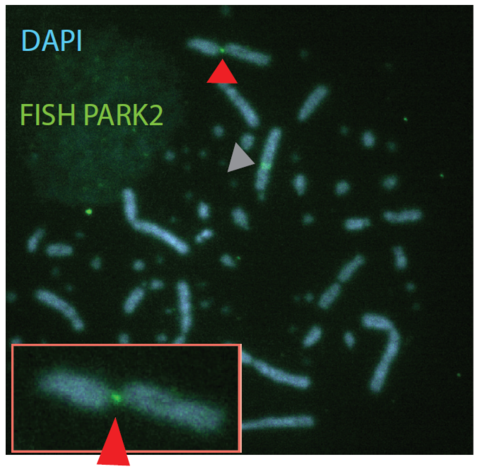 <b>Figure 2:</b> Metaphase spread from chicken DT40 cells, treated with the replication inhibitor aphidicolin. The FISH probe hybridizes to PARK2, which is broken (close up image in red box and red arrowheads). One allele of PARK2 is not broken (grey arrowhead). (from Pentzold et al., 2017)