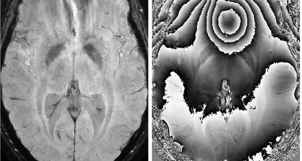 Abb. 1: Konventionelles Gradientenecho-Betragsbild (links) und dazugehöriges Phasenbild (rechts) des menschlichen Gehirns. Bei den dargestellten Bildern handelt es sich um unprozessierte Bilder, wie sie an einem klinischen MRT-Gerät gemessen werden können (Magnetfeldstärke 3T).