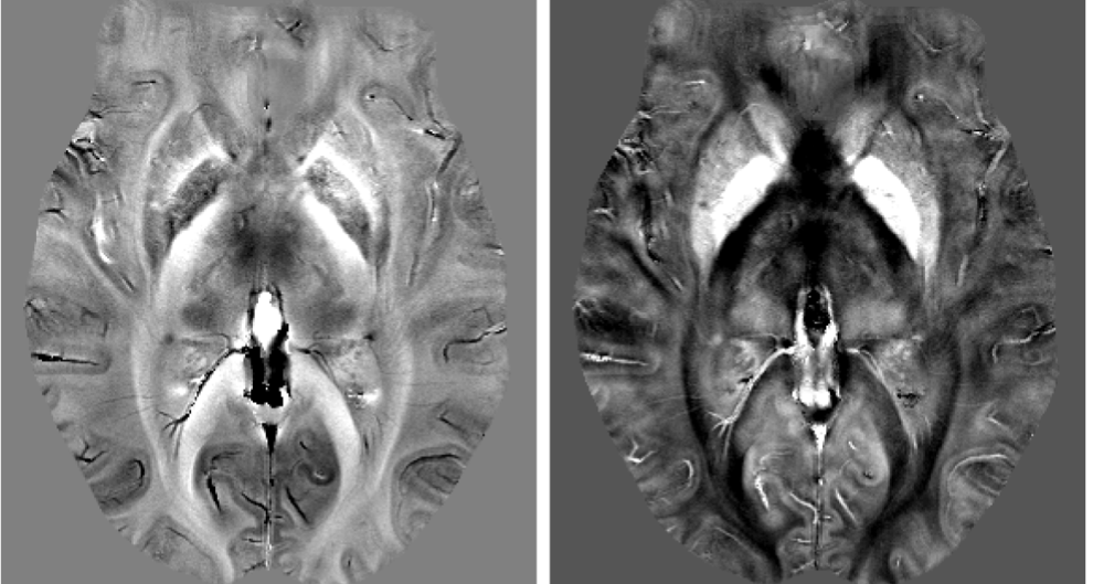 Abb. 2: Links ist ein korrigiertes Phasenbild dargestellt, das mit einem in unserer Gruppe entwickelten Korrekturverfahren, SHARP, aus den Messdaten berechnet wurde. Basierend auf diesem Bild kann eine Karte der magnetischen Suszeptibilität berechnet werden. Eine solche Karte ist im rechten Bild dargestellt. Der variierende Eisengehalt in den Kernen der Basalganglien wie Pallidum, Thalamus oder Putamen, ist in diesem Bild deutlich sichtbar.