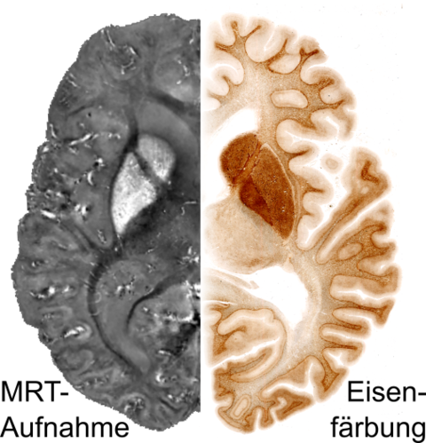 Abb. 3: Suszeptibilitätskarte der linken Hirnhälfte (links) und histologisch aufbereitete Eisenfärbung der rechten Hirnhälfte (rechts) desselben Gehirns. Helle Signalintensitäten im MRT-Bild und verstärkte Bräunung in der Eisenfärbung kennzeichnen erhöhte Eisenkonzentrationen. Diese Darstellung konnte durch Unterstützung von Kollegen der Fachhochschule Klagenfurt und der Medizinischen Universität Wien realisiert werden.

