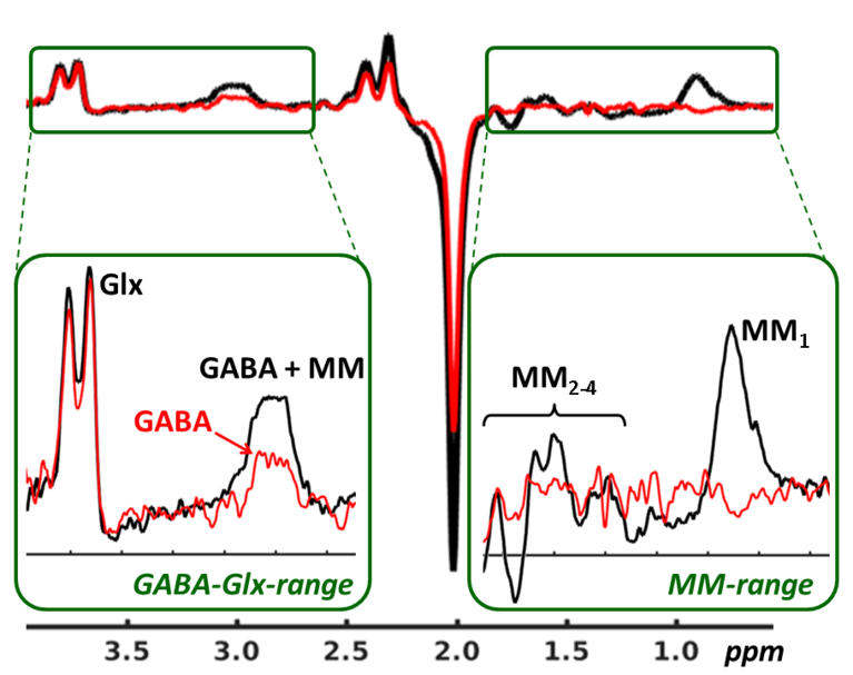 Edited 1H-MR brain spectra (MEGA-PRESS technique, 3T, TE/TR=69/300 ms, posterior cingulate cortex) acquired without (black graph) and with (red graph) inversion recovery based suppression of macromolecular resonances.