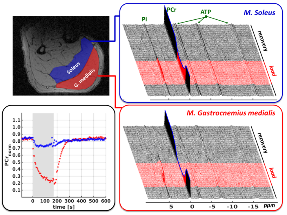 Functional 31P-MRS in loaded calf muscles. The applied pulse sequence allows interleaved acquisition of dynamic spectra series in multiple, differently loaded muscle groups (blue upper right chart: M. Soleus; red lower right chart: M. Gastocnemius Medialis).