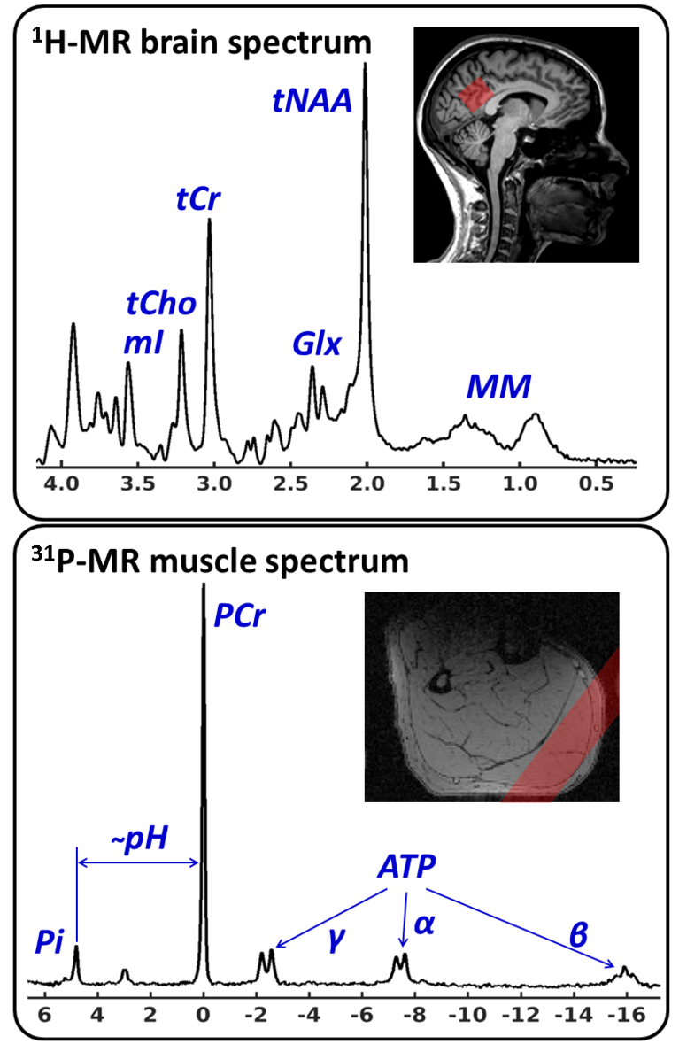 In vivo MR Spektren aus dem Gehirn (1H, oben) und aus dem Wadenmuskel (31P, unten)