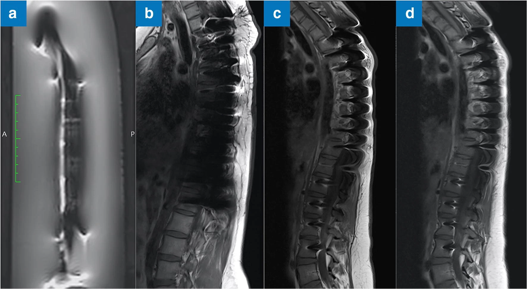 Heinrich, A. et al. MRI following scoliosis surgery? An analysis of implant heating, displacement, torque, and susceptibility artifacts. Eur Radiol 31, 4298–4307 (2021).