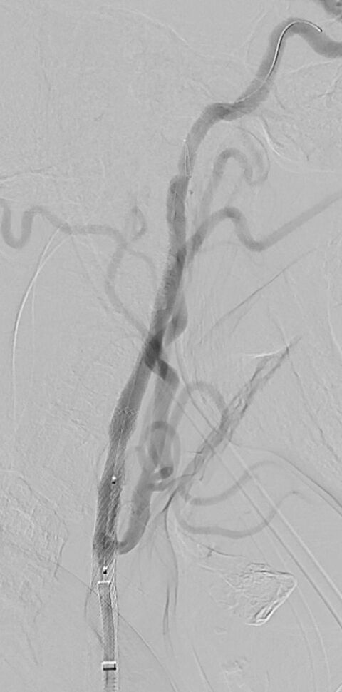 Nach Implantation eines Stents und Ballon-PTA Wiederherstellung des regulären Gefäßdurchmessers