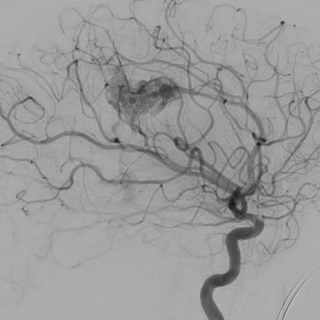 Von der vorderen Hirnarterie (A. cerebri anterior) versorgte AVM