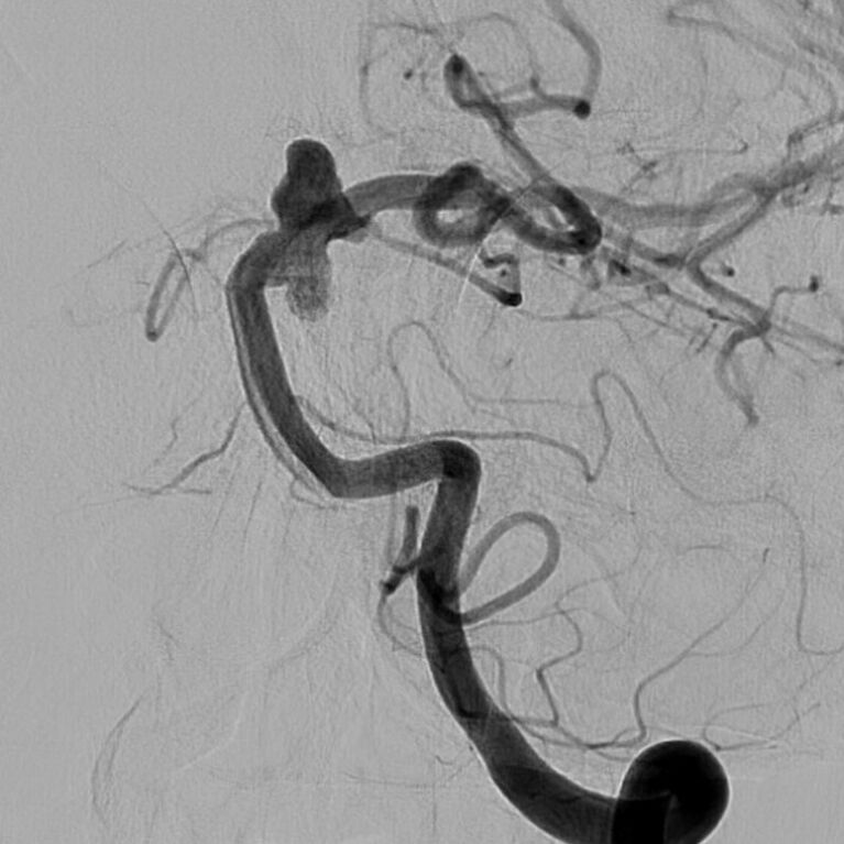 Komplexes Aneurysma der Arteria basilaris