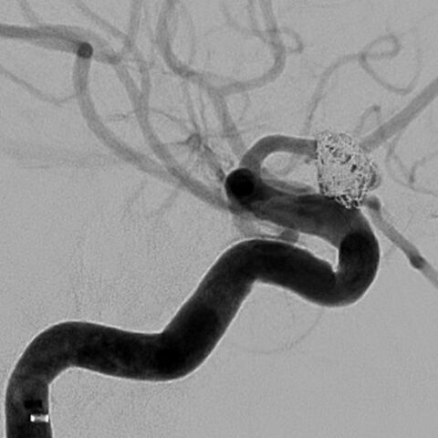 In der Abschlusskontrolle ist das Aneurysma mit Coils verschlossen und das Trägergefäß frei durchflossen