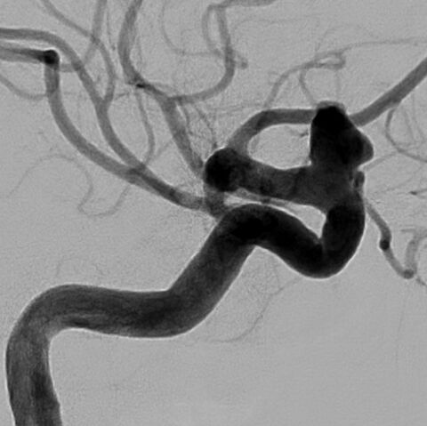 Aneurysma der inneren Hirnarterie (A. carotis interna) am Abgang der A. ophthalmica