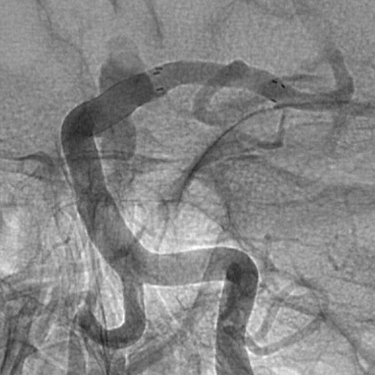 Flow Diverter und Stent