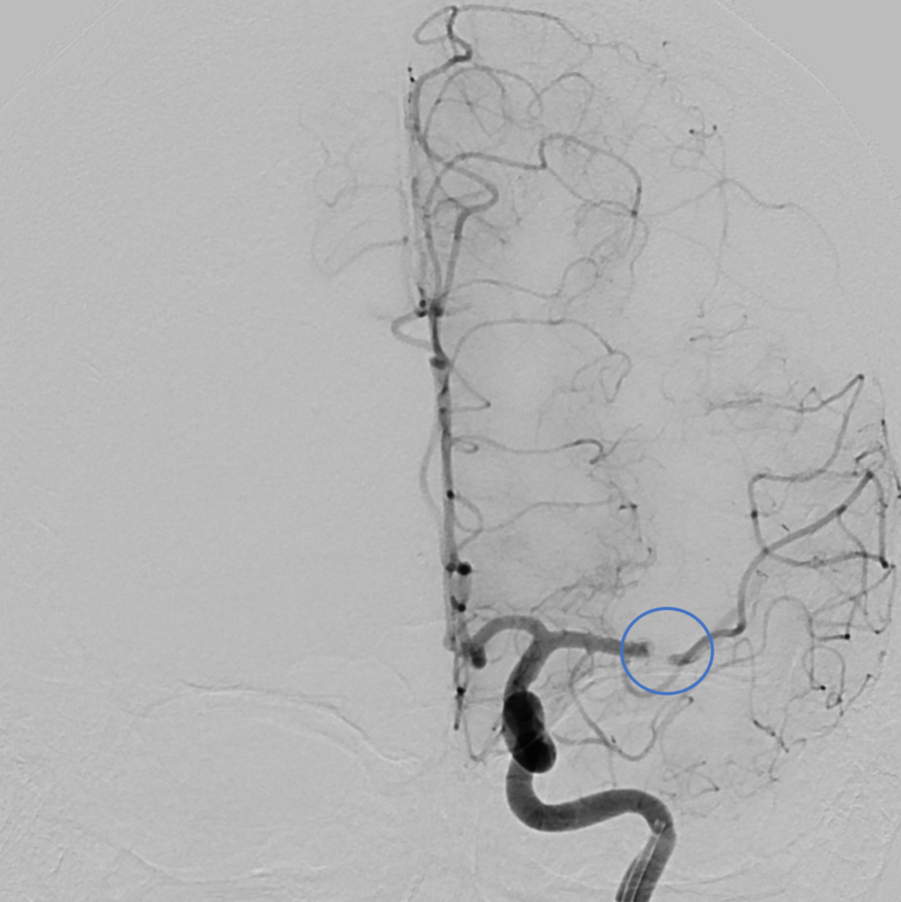 Embolus in der linken A. cerebri media (Kreis)