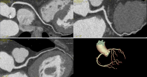 Koronarrekonstruktion mittels TAVI CT bei 83-jähriger Patientin mit Vorhofflimmern