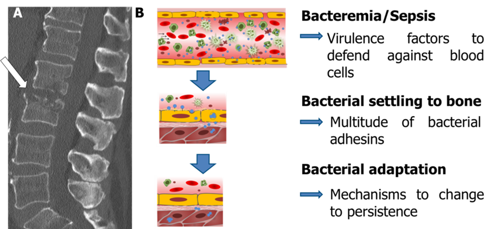 A: S. aureus spondylodiscitis/osteomyelitis with vertebral body destruction; B: Pathogenesis steps in hematogenous osteomyelitis